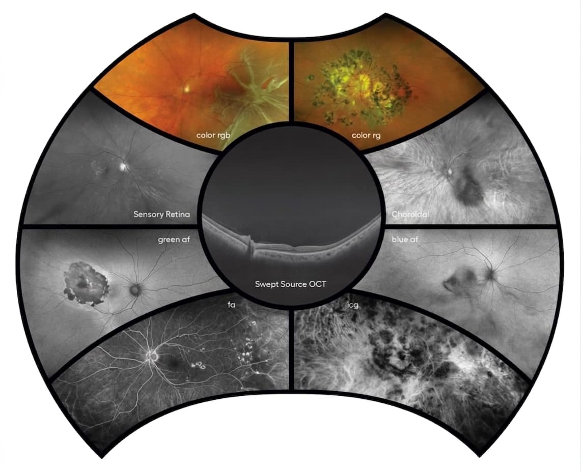 Ultra Geniş Açı Retina Görüntüleme Cihazları (UWF)