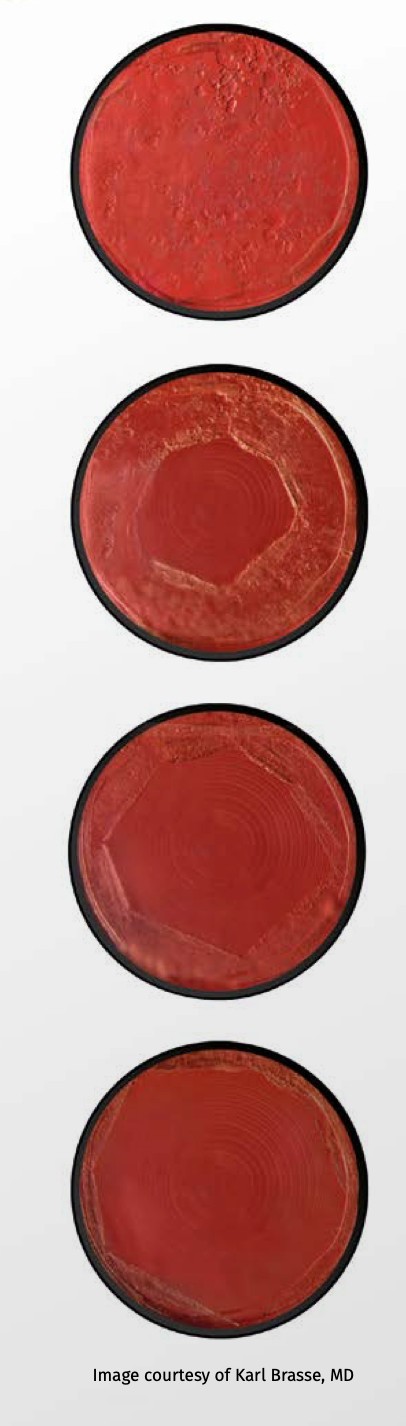 Ellex Tango Reflex Neo SLT – YAG – Vitreolysis Lazer